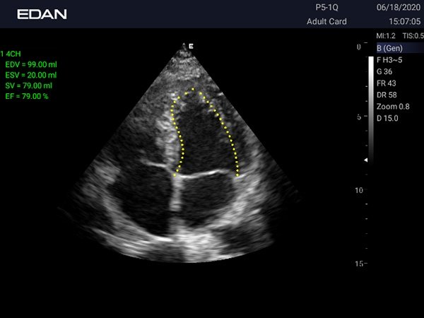 Edan Acclarix AX3 УЗИ-сканер