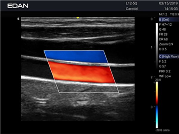 Edan Acclarix AX3 УЗИ-сканер